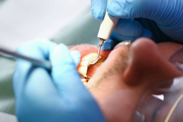Best Emergency Root Canal Treatment in Iowa Colony, TX