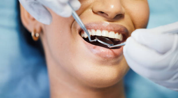 Best Emergency Tooth Extraction in Iowa Colony, TX
