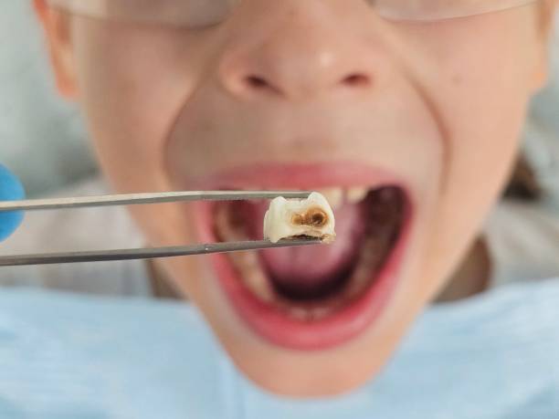 Best Emergency Treatment for Toothache in Iowa Colony, TX